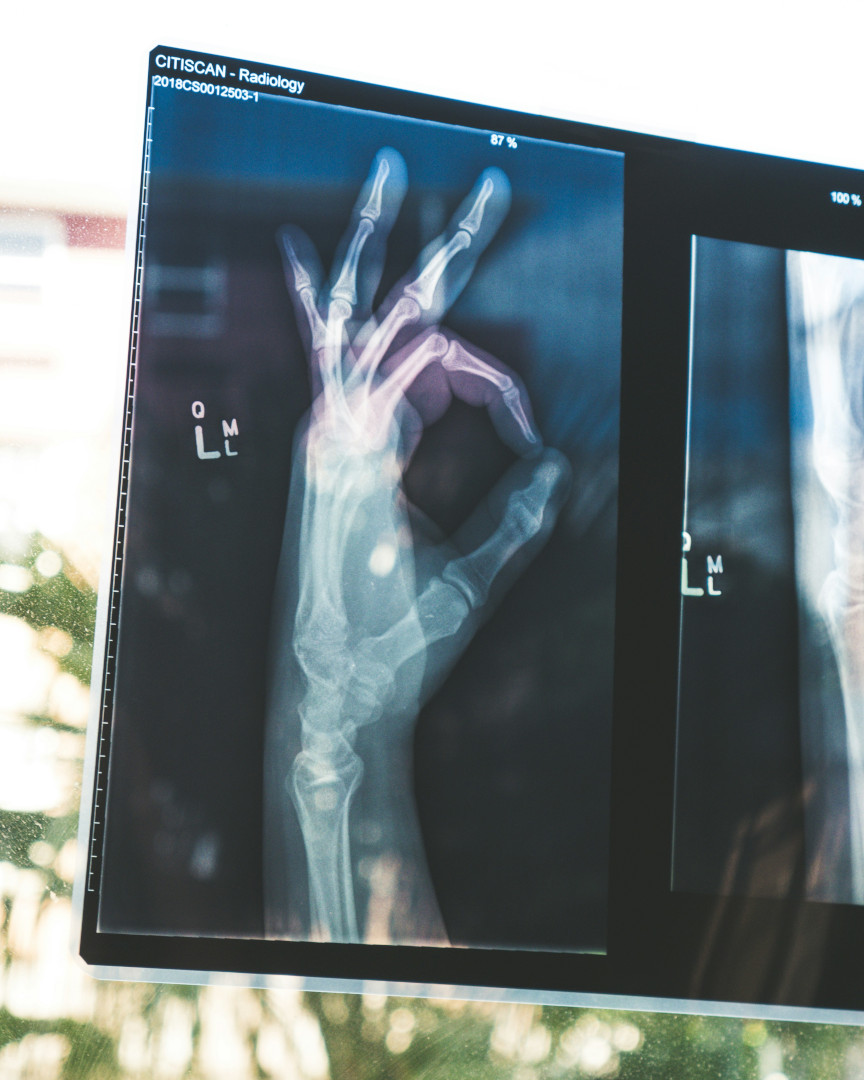 Soutenir la réparation osseuse suite à une fracture avec la gemmothérapie